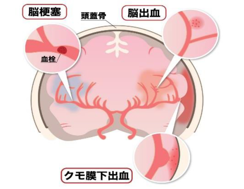 脳梗塞・脳出血